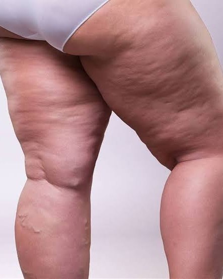 Clinical photo of legs and buttocks showing fat buildup in the thighs and calves