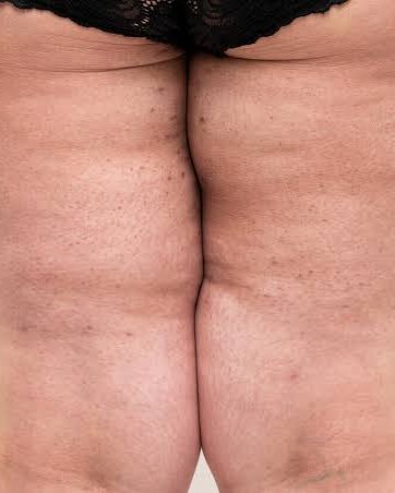 Clinical photo of the backs of the thighs showing changes in skin texture