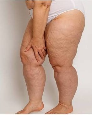 Clinical side view of legs showing increased volume down to the ankles, with the feet unaffected