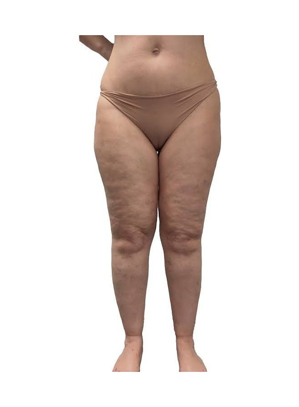 Clinical front view of legs showing disproportionate volume in the thighs and knees