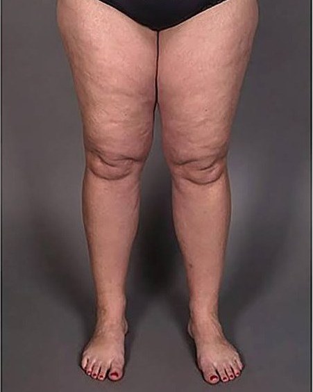 Clinical front view of legs showing uneven skin texture