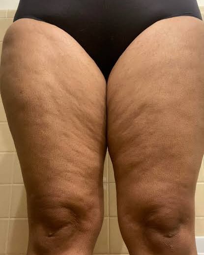 Photo of thighs and knees showing a nodular appearance and disproportionate volume